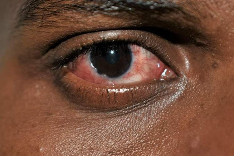 Red eye Outbreak