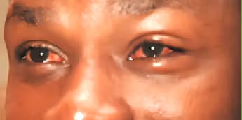 Causes, symptoms & how to prevent red eye disease
